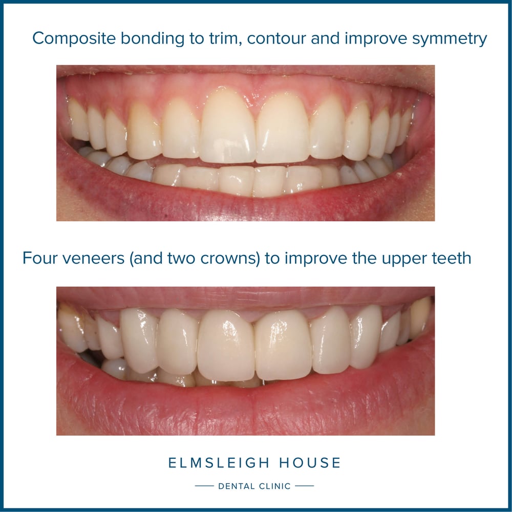 Composite bonding versus veneers key differences